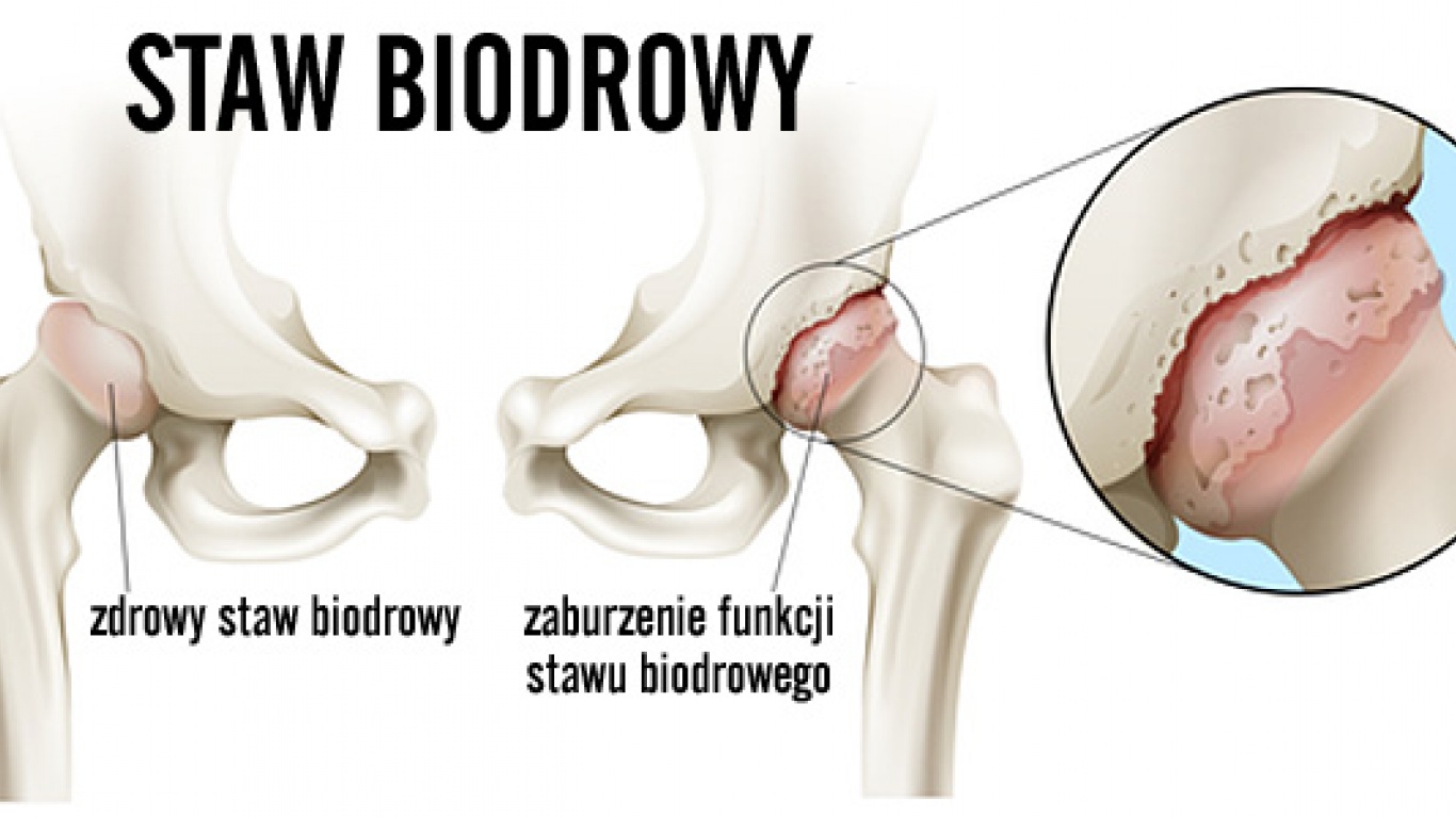 POSTĘPOWANIE TERAPEUTYCZNE W CHOROBIE ZWYRODNIENIOWEJ STAWU BIODROWEGO