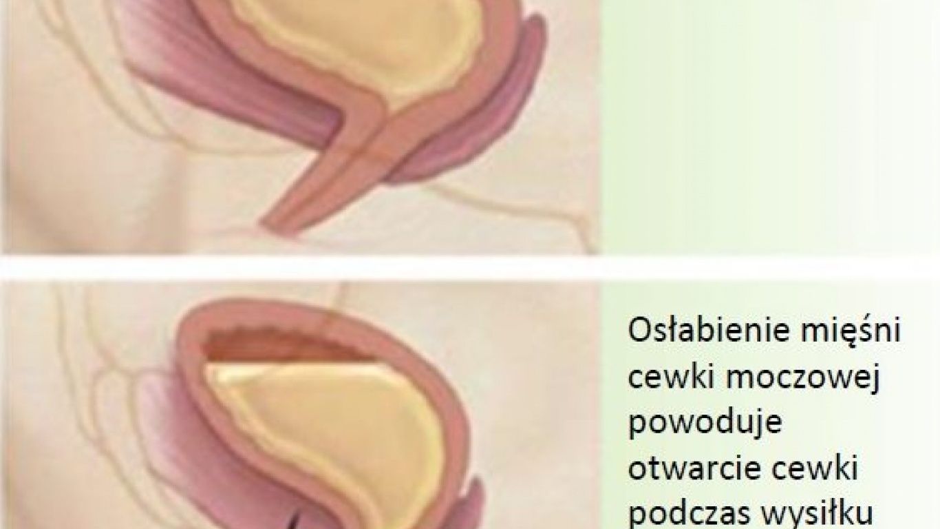 WYSIŁKOWE NIETRZYMANIE MOCZU